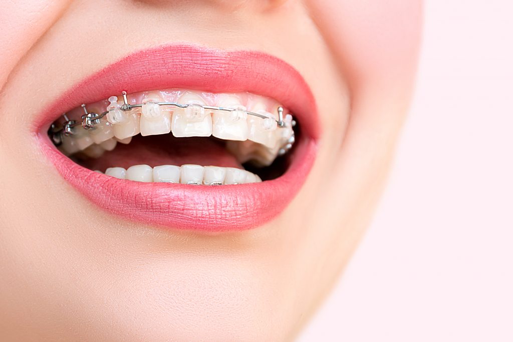 Ceramic Braces Mansfield Clear Braces Nottingham